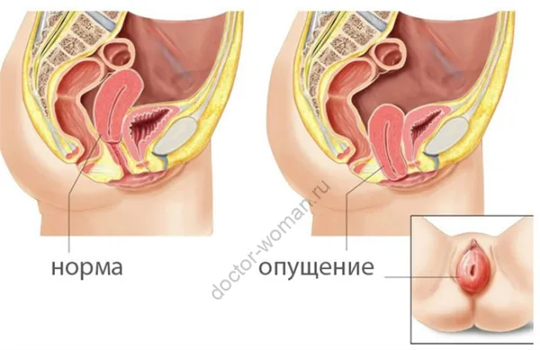 Опущение (пролапс) мочеполовых тазовых органов у женщин