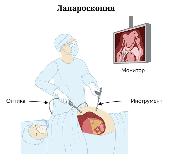 Что такое ГСГ маточных труб и как его делают 3