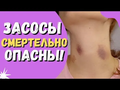 Как быстро свести засос на шее с помощью подручных средств 10