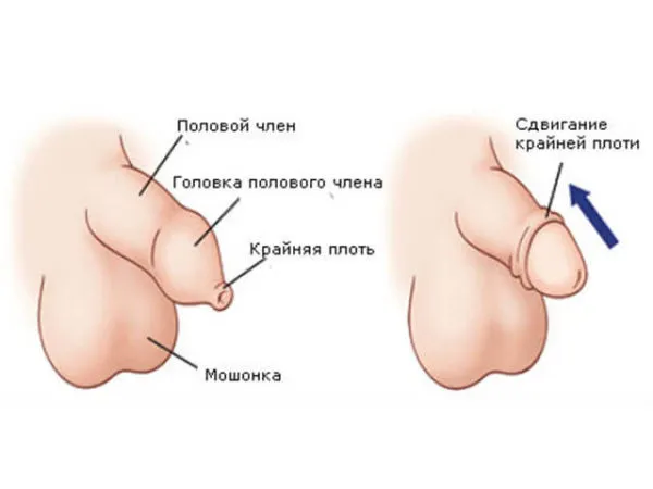 Чем отличается мужчина с обрезанным и необрезанным пенисом 4