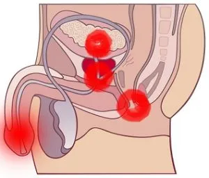 признаки простатита