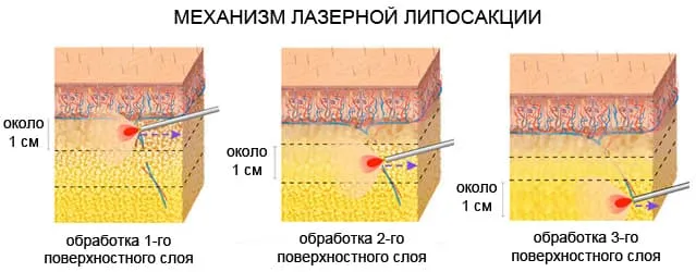 нанолипосакция