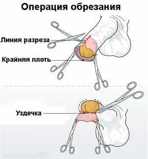 Как обрезание влияет на интимную жизнь, через сколько дней можно заниматься сексом 6