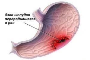 Язва желудка у любителей курить в затяг