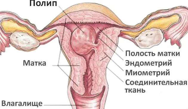 Как выглядит полипозное образование слизистой матки